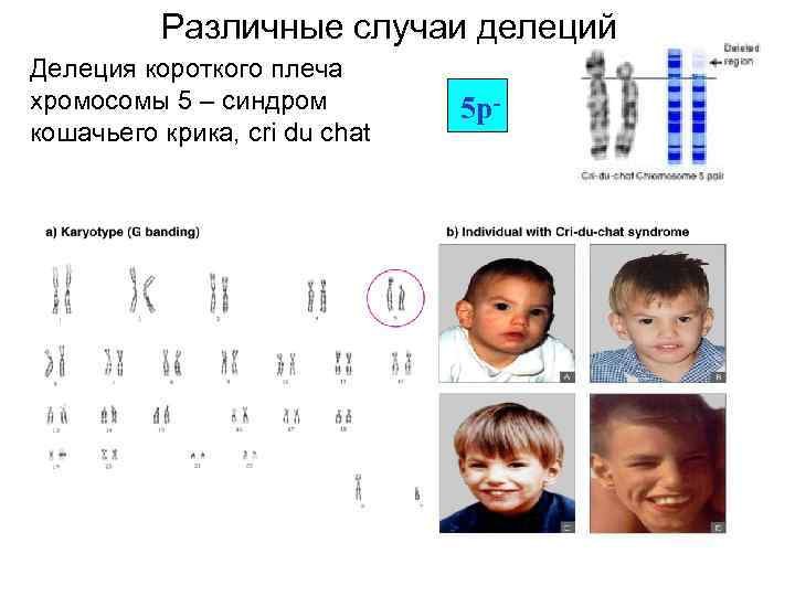 День синдрома дубликации хромосомы 15 октября