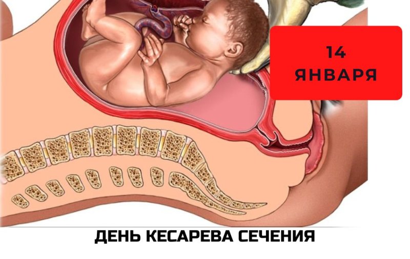 День кесарева сечения 14 января