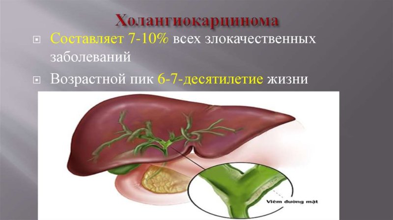 Всемирный день холангиокарциномы 12 февраля